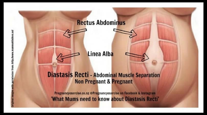 What does diastasis Recti look like