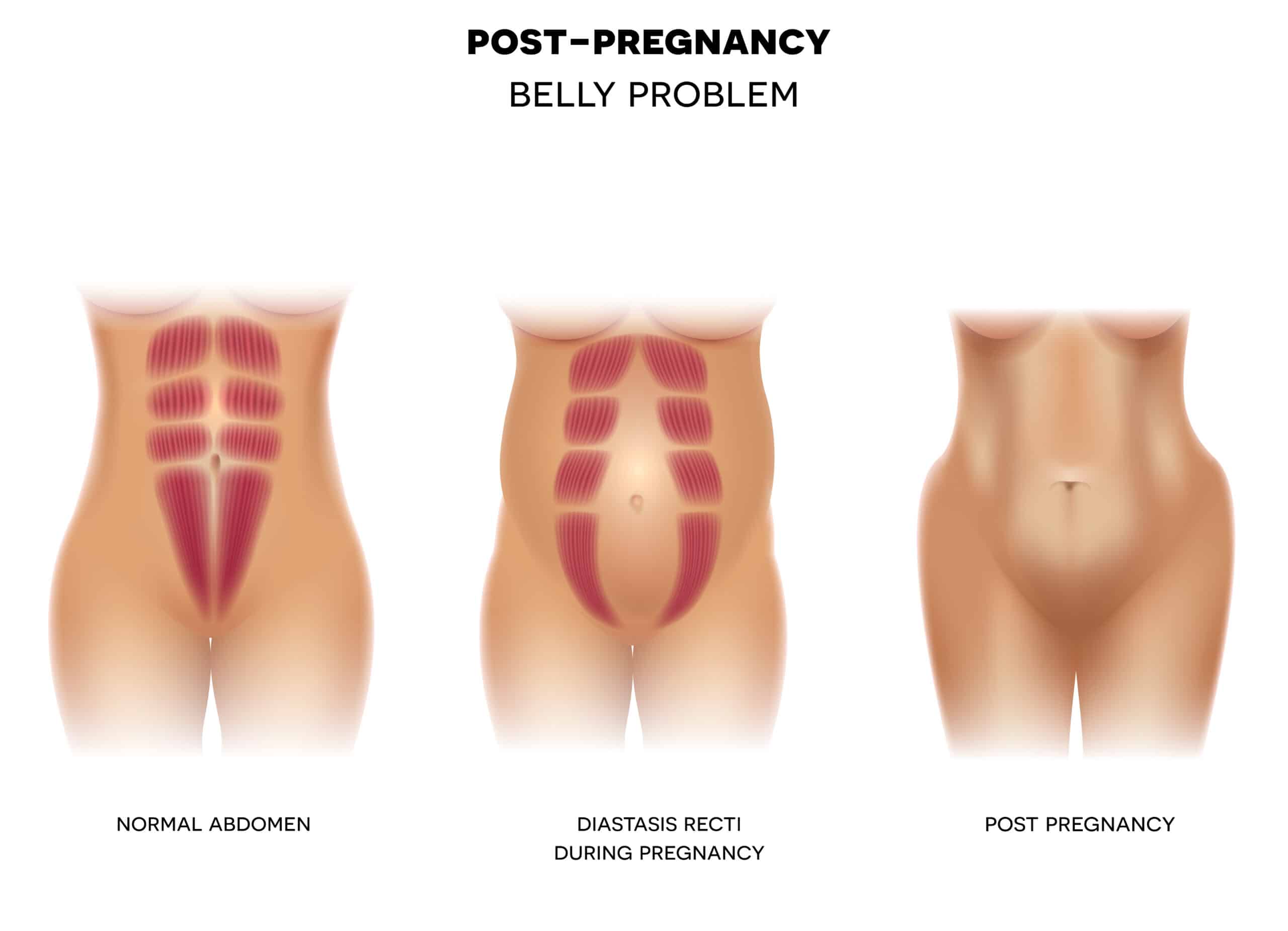 Peace Out Mummy Tummy-What is Diastasis Recti?