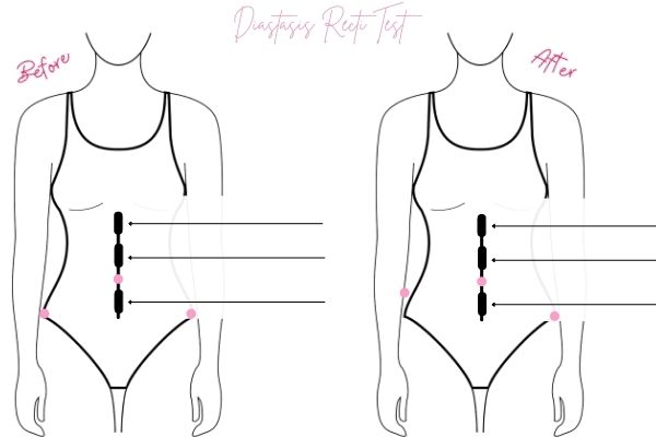 Diastasis Récti Test