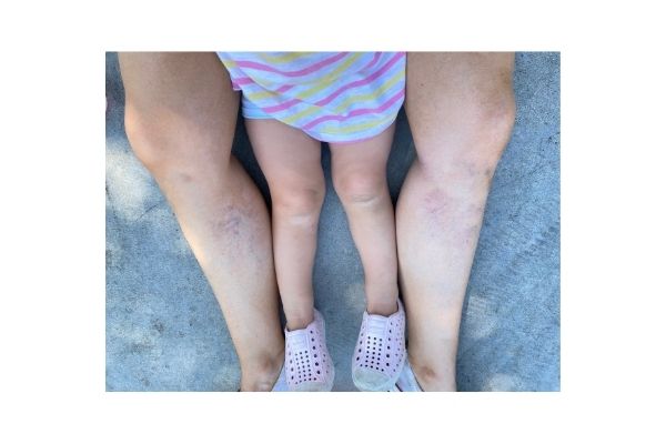 Mom sitting on the ground showing her varicose veins at 13 weeks pregnant