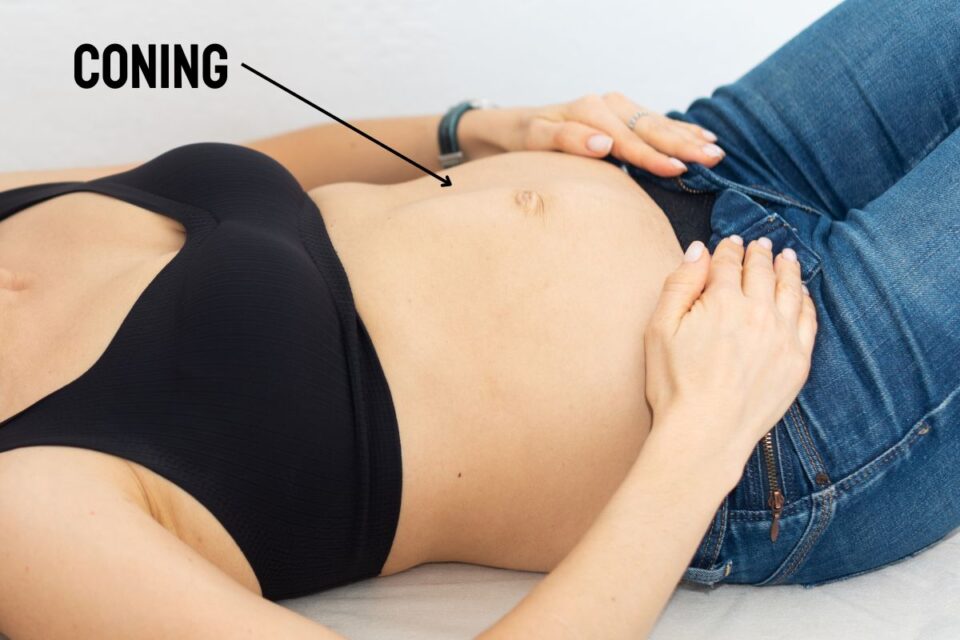Abdominal Coning During PregnancyThe Cause and Solution