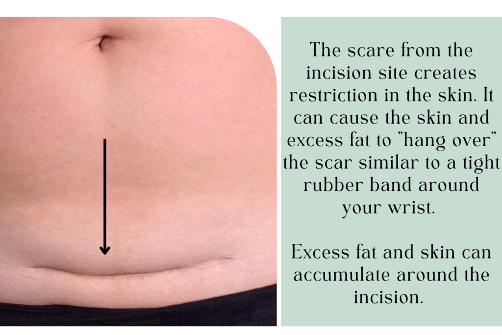 How To Reduce A C Section Belly Overhang Naturally No More Hiding 