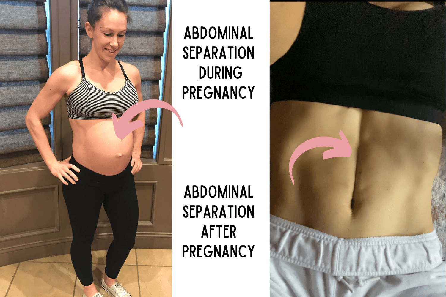 picture of pregnant mom with abdominal separation during pregnancy and postpartum