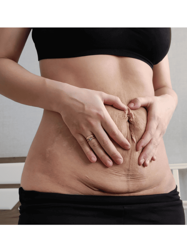 How To Get Rid Of a C-Section Overhang Naturally